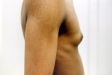 ofodile plastic surgery, male breast reduction