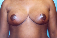 ofodile cosmetic surgery, breast reconstruction