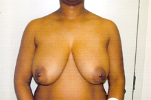 ofodile plastic surgery, breast reduction