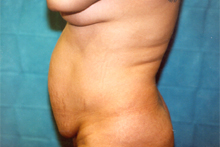 ofodile plastic surgery, body contouring