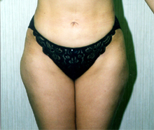 ofodile plastic surgery, fat removal
